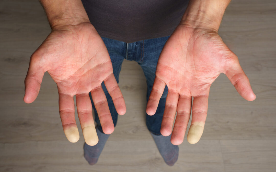 Chiropractic Care and Raynaud’s Disease